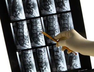 Chiropractic care at Advanced Spinal Care gets results