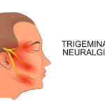 What is Trigeminal Neuralgia? Basics About the Condition